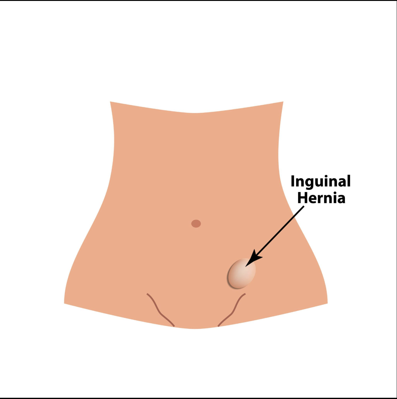 Procedimiento: Hernia Inguinal